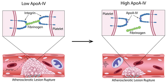 Infographic about an athersclerotic lesion rupture