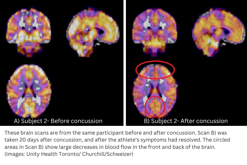 These brain scans are from the same participant before and after concussion. Scan B was taken 20 days after concussion, and after the athlete's symptoms had resolved. The circled areas in Scan B show large decreases in blood flow in the front and back of the brain.